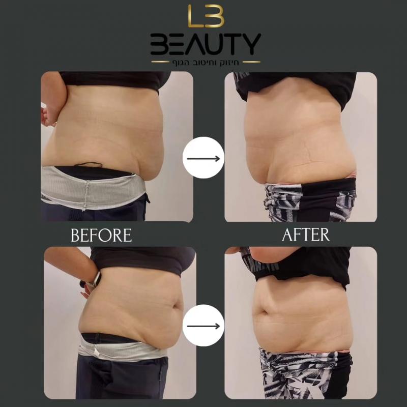 Лейзер для волос, RF , Ультраформер 3