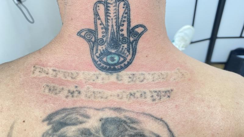 Лазерное удаление татуировок и татуажа