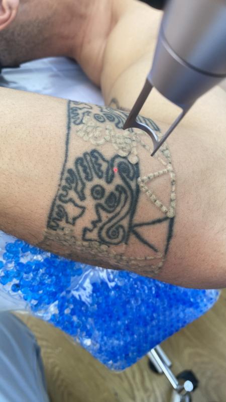 Лазерное удаление татуировок и татуажа