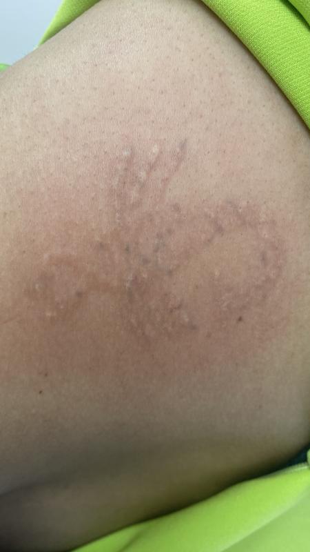 Лазерное удаление татуировок и татуажа