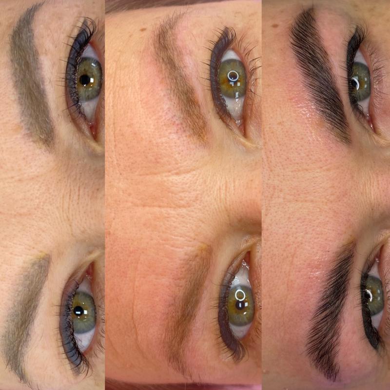 Лазерное удаление татуировок и татуажа