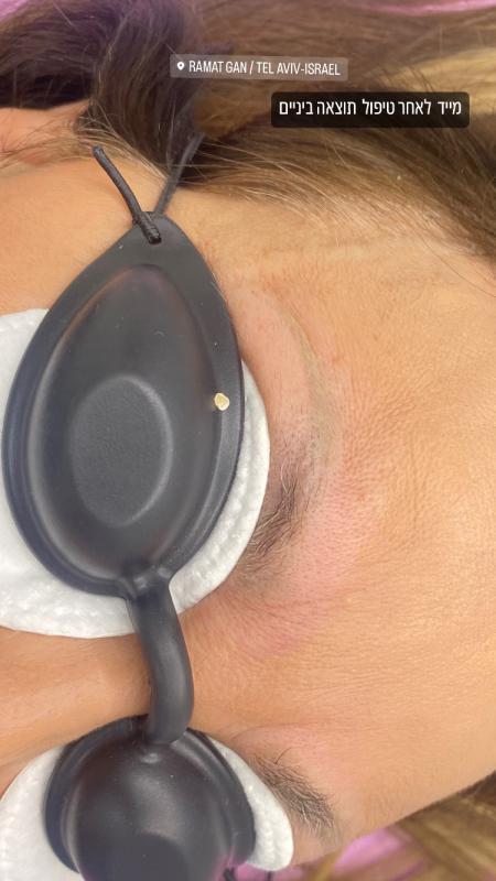 Лазерное удаление татуировок и татуажа