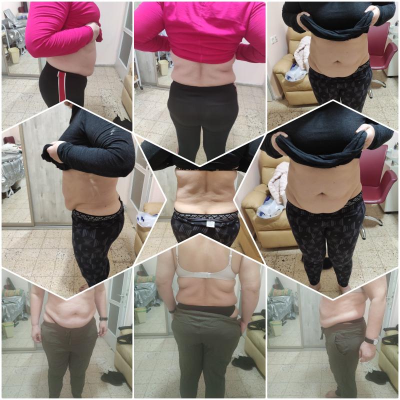 Прессо терапия, ручная липосакция, антицеллюлитный  массаж