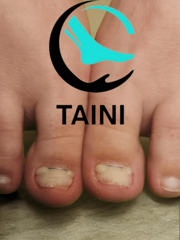 Титановая нить и забота о ногтевой пластине טטיאנה Татьяна +972504592830