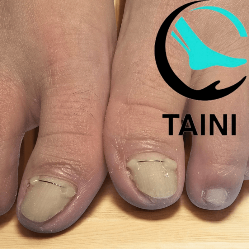 Титановая нить и забота о ногтевой пластине טטיאנה Татьяна +972504592830