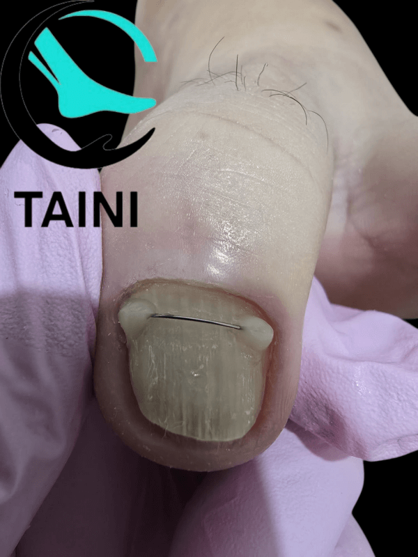 Титановая нить и забота о ногтевой пластине טטיאנה Татьяна +972504592830