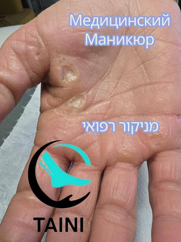 Медицинский Педикюр, Подолог в Петах-Тикве! פדיקור רפואי ומניקור בפתח